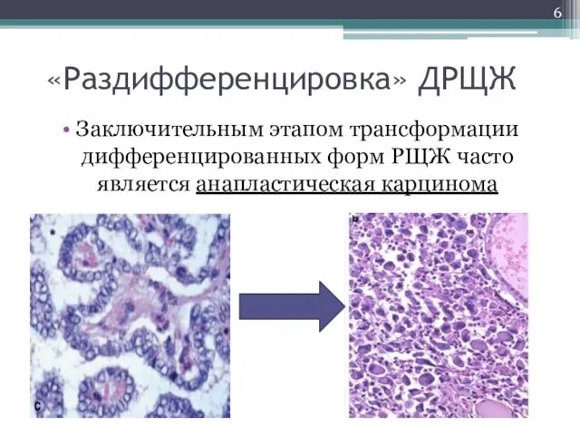 «Раздифференцировка» ДРЩЖ Заключительным этапом трансформации дифференцированных форм РЩЖ часто является анапластическая карцинома