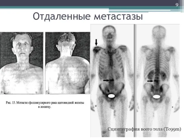 Отдаленные метастазы Сцинтиграфия всего тела (Тс99m)