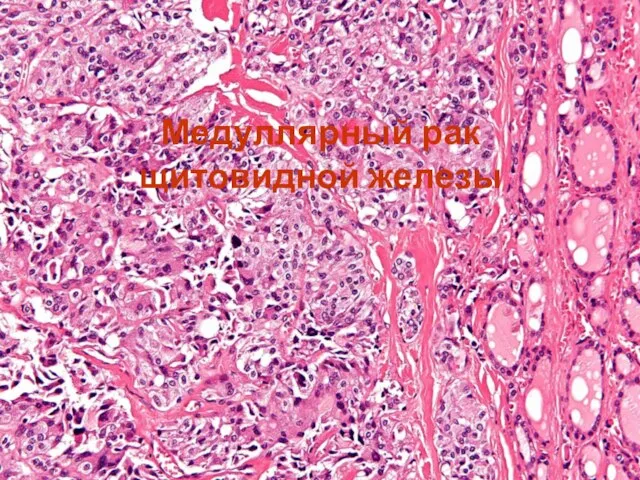 Медуллярный рак щитовидной железы