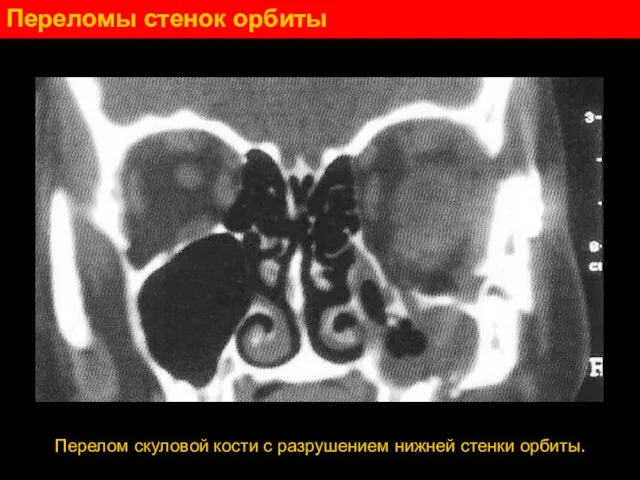 Переломы стенок орбиты Перелом скуловой кости с разрушением нижней стенки орбиты.