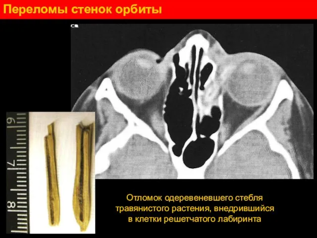 Переломы стенок орбиты Отломок одеревеневшего стебля травянистого растения, внедрившийся в клетки решетчатого лабиринта