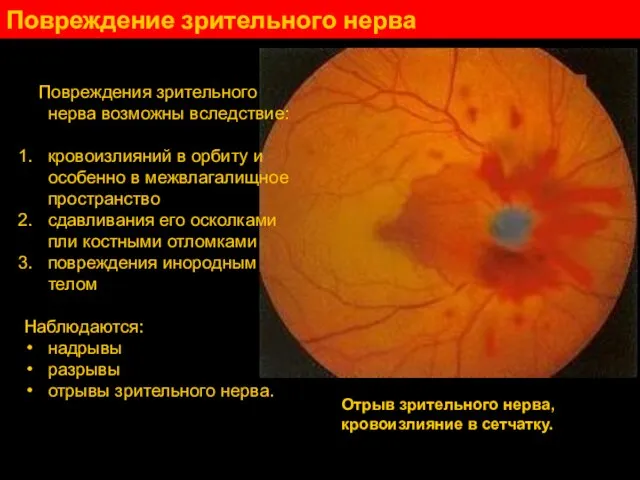 Повреждение зрительного нерва Повреждения зрительного нерва возможны вследствие: кровоизлияний в opбиту и