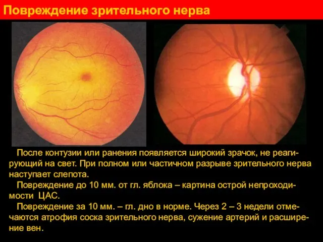 Повреждение зрительного нерва После контузии или ранения появляется широкий зрачок, не реаги-рующий