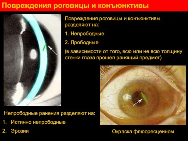 Повреждения роговицы и конъюнктивы Непрободные ранения разделяют на: Истинно непрободные Эрозии Повреждения