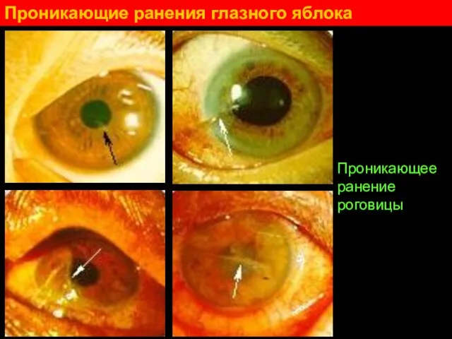 Проникающие ранения глазного яблока Проникающее ранение роговицы