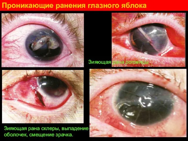 Проникающие ранения глазного яблока Зияющая рана склеры, выпадение оболочек, смещение зрачка. Зияющая рана роговицы