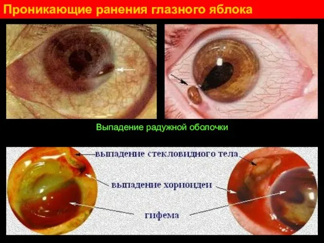 Проникающие ранения глазного яблока Выпадение радужной оболочки