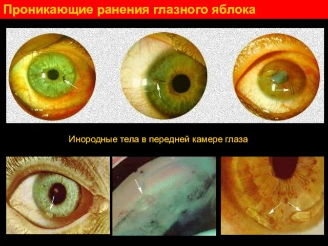 Проникающие ранения глазного яблока Инородные тела в передней камере глаза