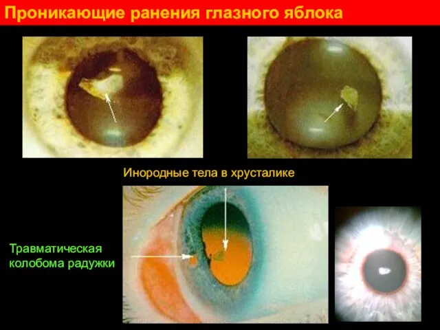 Проникающие ранения глазного яблока Инородные тела в хрусталике Травматическая колобома радужки