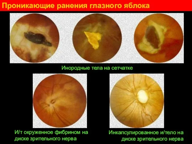 Проникающие ранения глазного яблока Инородные тела на сетчатке И/т окруженное фибрином на