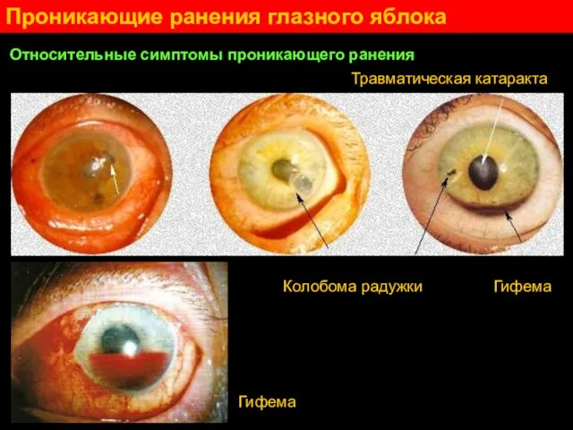Проникающие ранения глазного яблока Относительные симптомы проникающего ранения Колобома радужки Гифема Травматическая катаракта Гифема