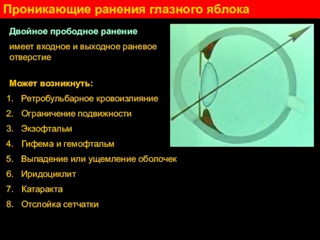 Проникающие ранения глазного яблока Двойное прободное ранение имеет входное и выходное раневое