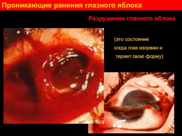 Проникающие ранения глазного яблока Разрушение глазного яблока (это состояние когда глаз изорван и теряет свою форму)