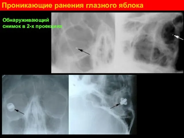 Проникающие ранения глазного яблока Обнаруживающий снимок в 2-х проекциях