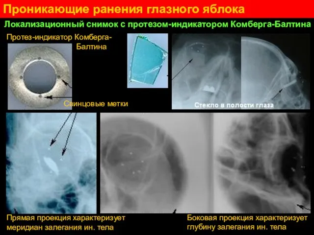 Проникающие ранения глазного яблока Локализационный снимок с протезом-индикатором Комберга-Балтина Протез-индикатор Комберга- Балтина