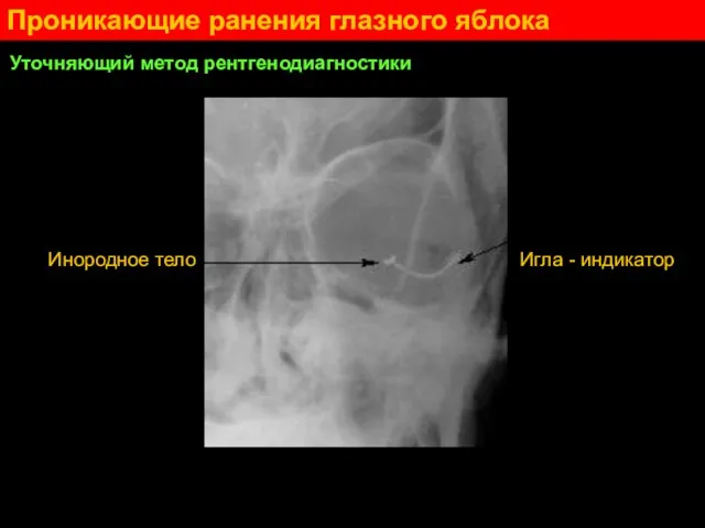 Проникающие ранения глазного яблока Уточняющий метод рентгенодиагностики Инородное тело Игла - индикатор