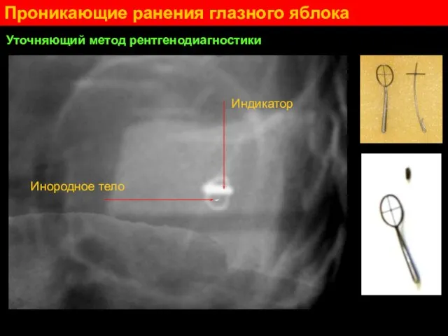 Проникающие ранения глазного яблока Уточняющий метод рентгенодиагностики Инородное тело Индикатор