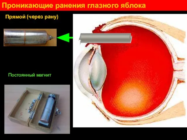 Проникающие ранения глазного яблока Прямой (через рану) Инородное тело Постоянный магнит