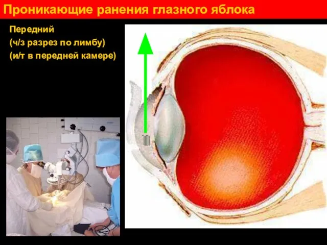 Проникающие ранения глазного яблока Передний (ч/з разрез по лимбу) (и/т в передней камере)