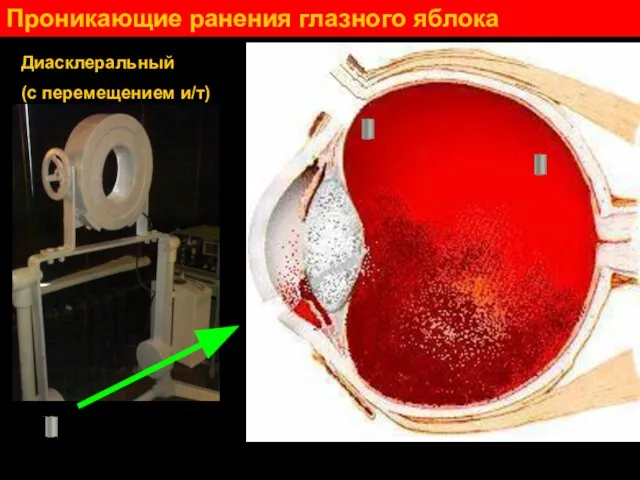 Проникающие ранения глазного яблока Диасклеральный (с перемещением и/т)