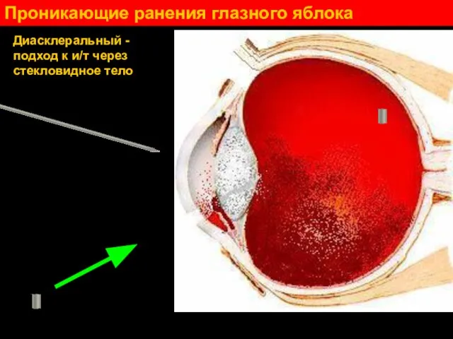 Проникающие ранения глазного яблока Диасклеральный - подход к и/т через стекловидное тело