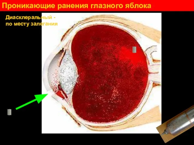 Проникающие ранения глазного яблока Диасклеральный - по месту залегания