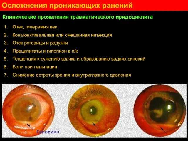 Осложнения проникающих ранений Клинические проявления травматического иридоциклита Отек, гиперемия век Конъюнктивальная или