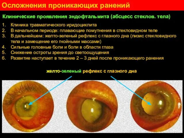 Клинические проявления эндофтальмита (абсцесс стеклов. тела) Клиника травматического иридоциклита В начальном периоде: