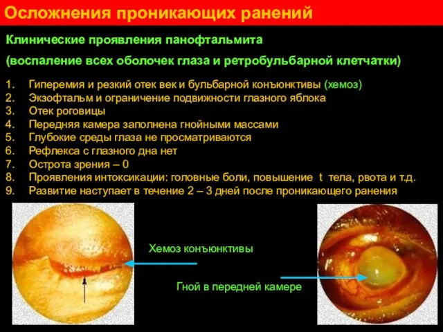 Клинические проявления панофтальмита (воспаление всех оболочек глаза и ретробульбарной клетчатки) Гиперемия и