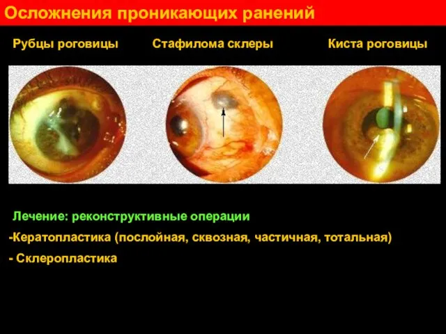 Осложнения проникающих ранений Рубцы роговицы Стафилома склеры Киста роговицы Лечение: реконструктивные операции