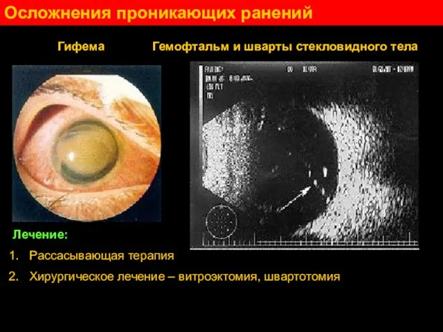 Осложнения проникающих ранений Гифема Гемофтальм и шварты стекловидного тела Лечение: Рассасывающая терапия