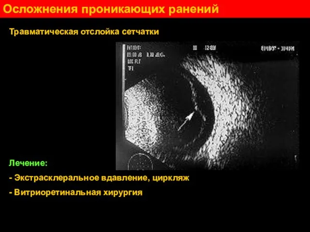 Осложнения проникающих ранений Травматическая отслойка сетчатки Лечение: - Экстрасклеральное вдавление, циркляж - Витриоретинальная хирургия