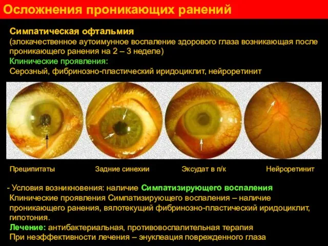 Симпатическая офтальмия (злокачественное аутоимунное воспаление здорового глаза возникающая после проникающего ранения на