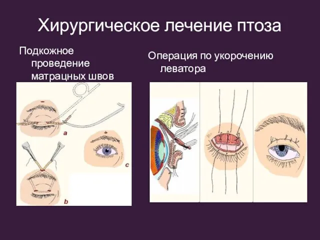 Хирургическое лечение птоза Подкожное проведение матрацных швов Операция по укорочению леватора