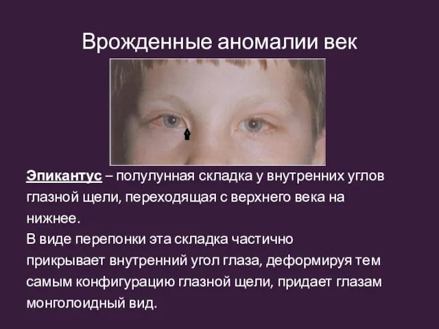 Врожденные аномалии век Эпикантус – полулунная складка у внутренних углов глазной щели,