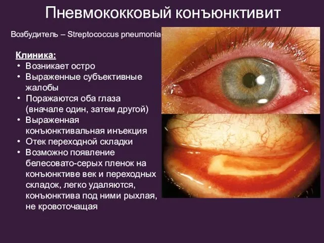 Пневмококковый конъюнктивит Возбудитель – Streptococcus pneumonia Клиника: Возникает остро Выраженные субъективные жалобы