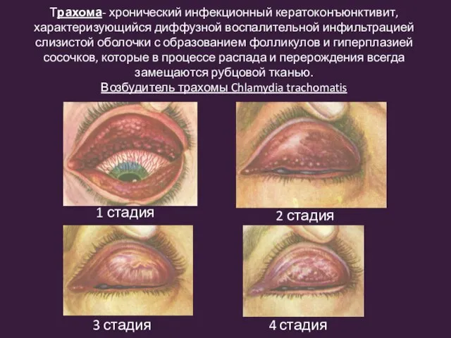 Трахома- хронический инфекционный кератоконъюнктивит, характеризующийся диффузной воспалительной инфильтрацией слизистой оболочки с образованием