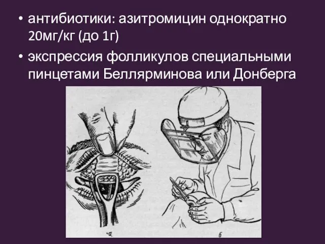 антибиотики: азитромицин однократно 20мг/кг (до 1г) экспрессия фолликулов специальными пинцетами Беллярминова или Донберга