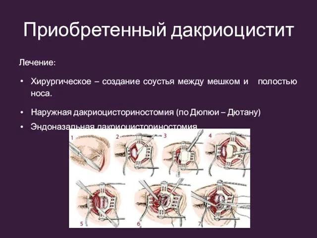 Приобретенный дакриоцистит Лечение: Хирургическое – создание соустья между мешком и полостью носа.