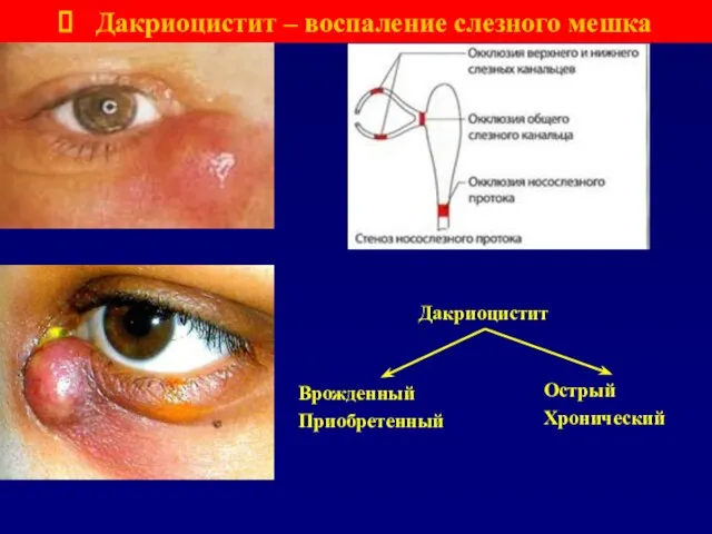 Дакриоцистит – воспаление слезного мешка Острый Хронический Врожденный Приобретенный Дакриоцистит