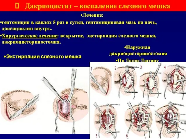 Дакриоцистит – воспаление слезного мешка Лечение: гентомицин в каплях 5 раз в