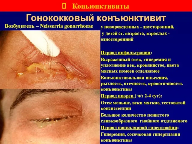 Гонококковый конъюнктивит Коньюнктивиты Возбудитель – Neisserria gonorrhoeae у новорожденных - двусторонний, у