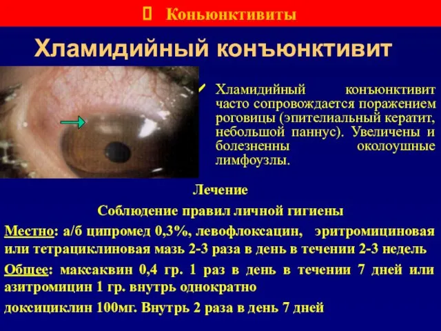 Хламидийный конъюнктивит Хламидийный конъюнктивит часто сопровождается поражением роговицы (эпителиальный кератит, небольшой паннус).