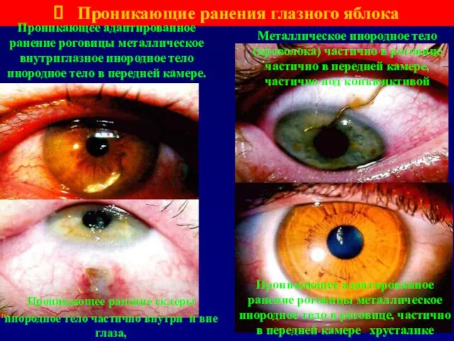 Проникающие ранения глазного яблока Проникающее адаптированное ранение роговицы металлическое внутриглазное инородное тело
