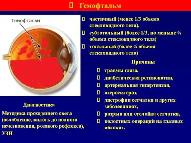 Гемофтальм частичный (менее 1/3 объема стекловидного тела), субтотальный (более 1/3, но меньше