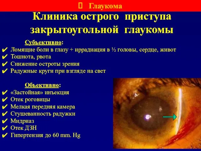 Клиника острого приступа закрытоугольной глаукомы Субъективно: Ломящие боли в глазу + иррадиация