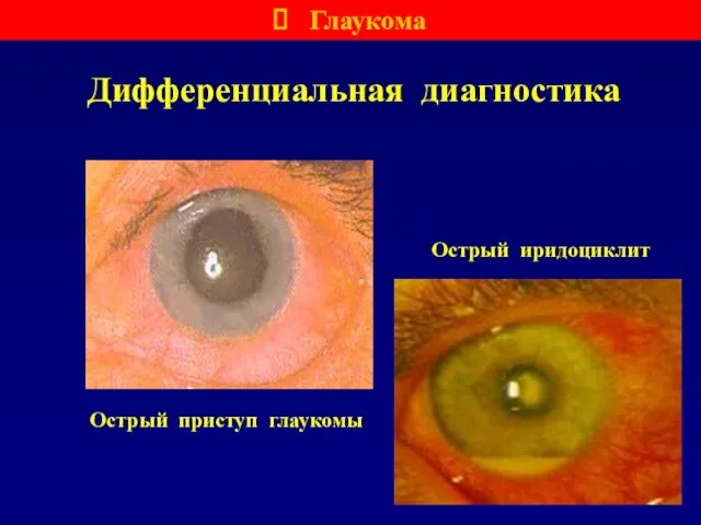 Дифференциальная диагностика Острый приступ глаукомы Острый иридоциклит Глаукома