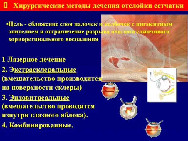 Цель - сближение слоя палочек и колбочек с пигментным эпителием и отграничение