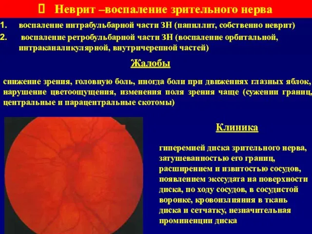 Неврит –воспаление зрительного нерва воспаление интрабульбарной части ЗН (папиллит, собственно неврит) воспаление