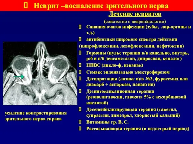 Лечение невритов (совместно с невропатологом) Неврит –воспаление зрительного нерва Санация очагов инфекции